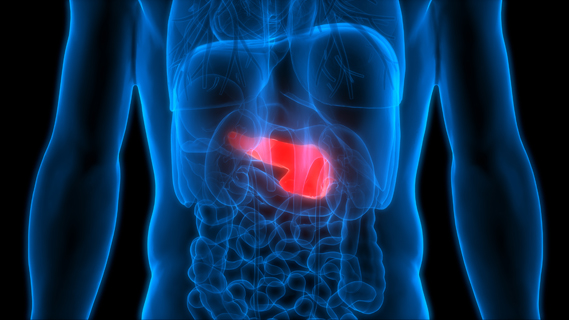 Pancreatic cancer