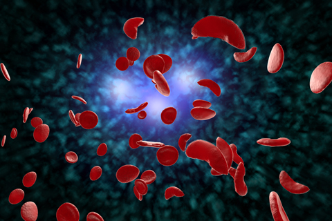 Sickle cell anaemia