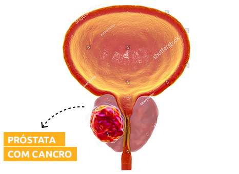 Associação Portuguesa de Doentes da Próstata