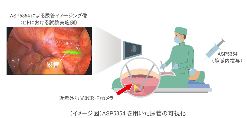 ASP5354を用いた尿管の可視化